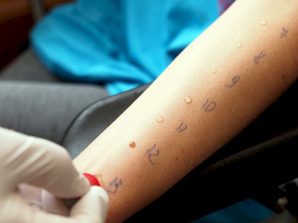 Testy skórne punktowe